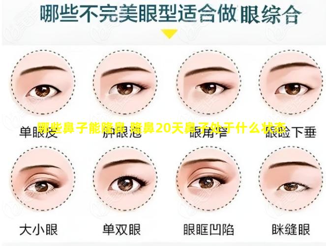 哪些鼻子能隆鼻 隆鼻20天鼻子处于什么状态